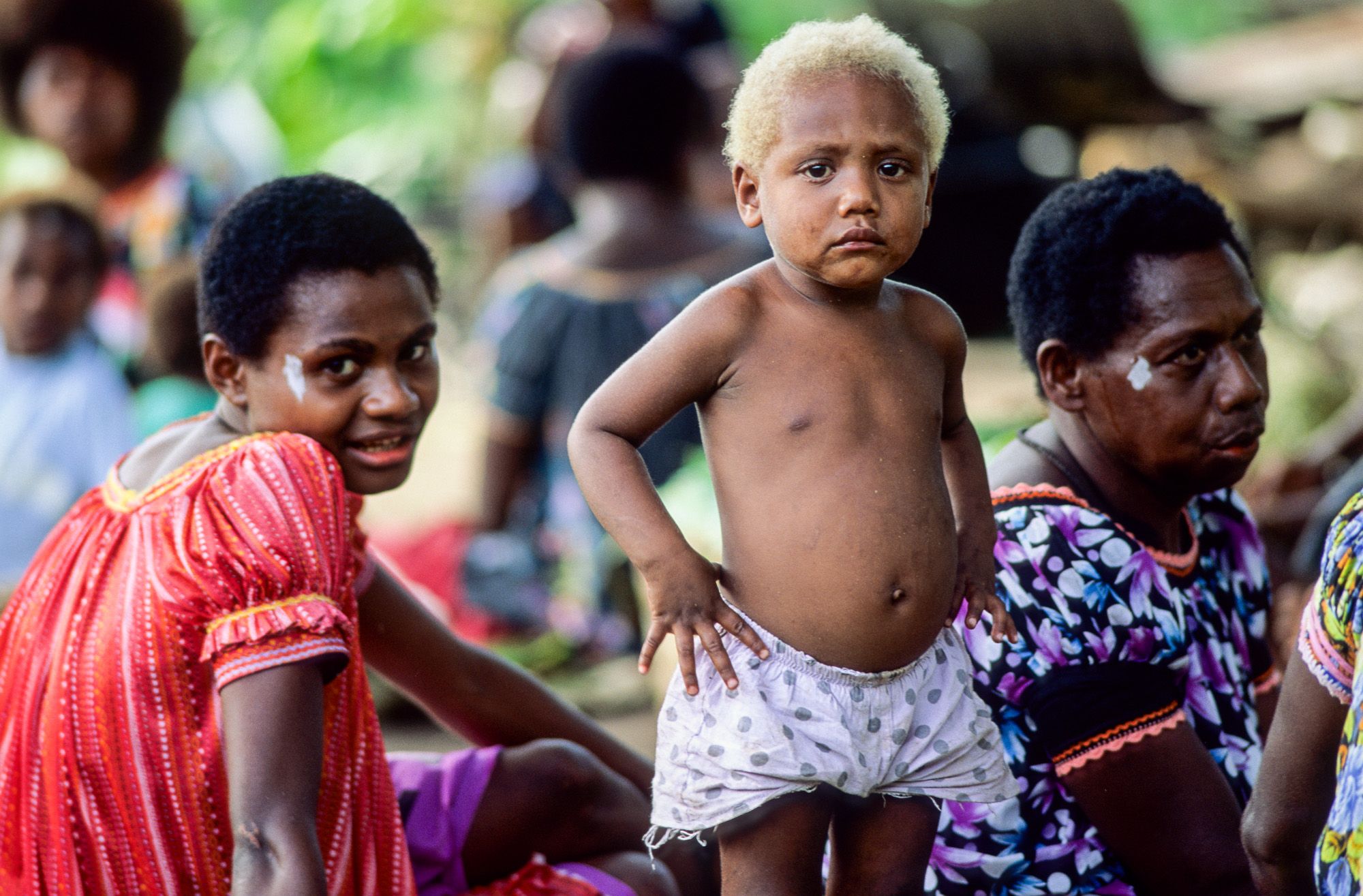 Nouvelle Guinée Papouasie. Rabaul, tribu des Tolaï. Beaucoup d'habitants sont blonds, à cause de la malnutrition qui sévit dans ses contrées perdues.