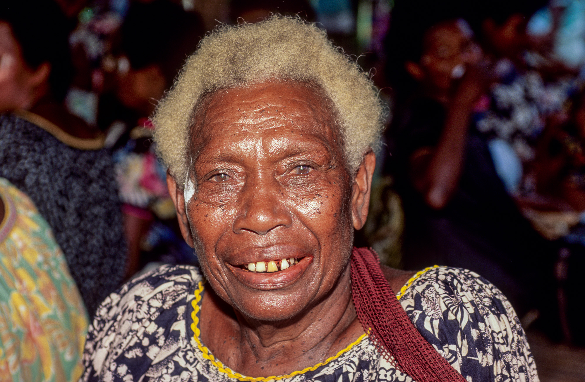 Nouvelle Guinée Papouasie. Rabaul, tribu des Tolaï. Beaucoup d'habitants sont blonds, à cause de la malnutrition qui sévit dans ses contrées perdues.