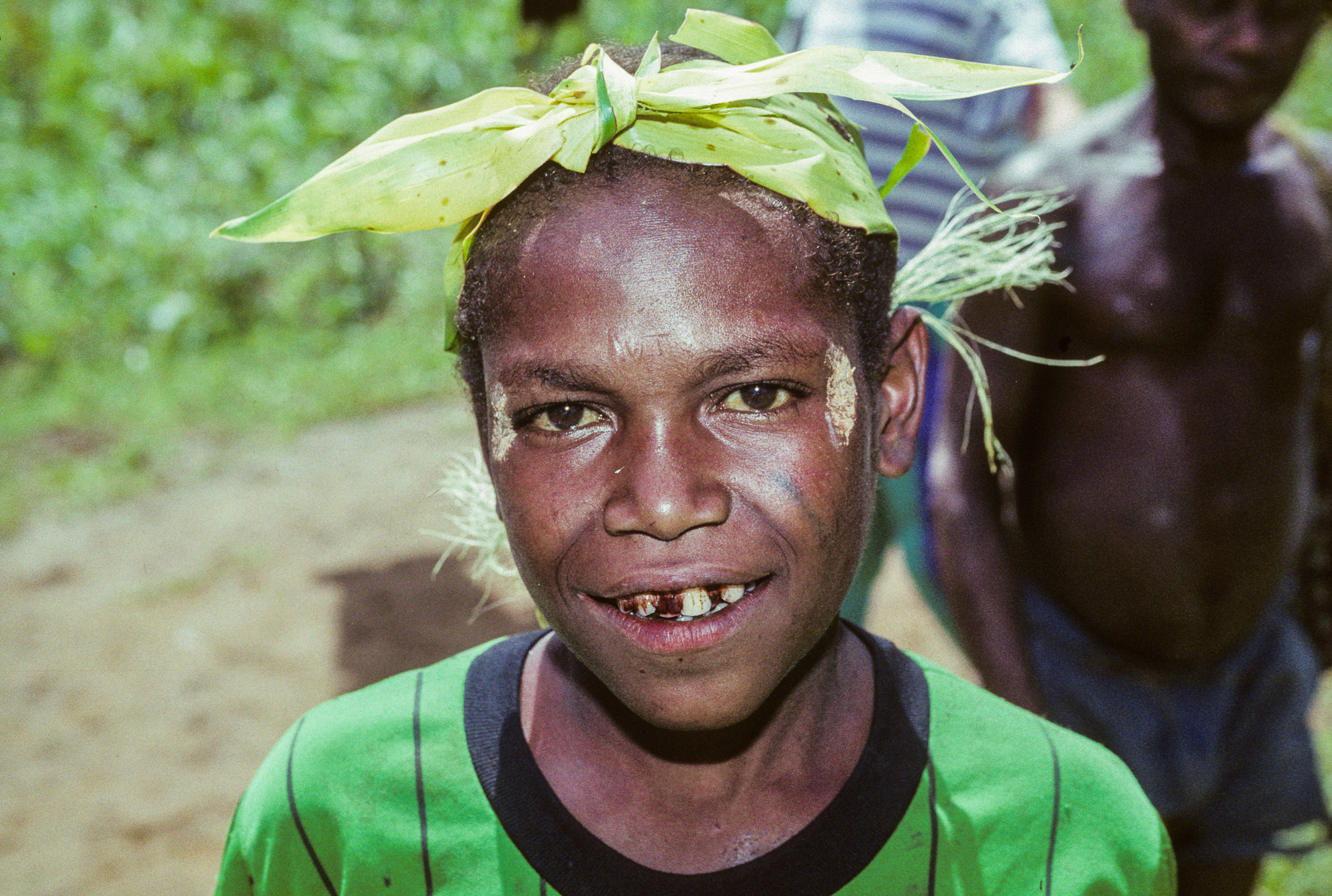 Nouvelle Guinée Papouasie. Rabaul, tribu des Tolaï. Cet enfant a les lèvres en sang car il mache du bétel additionné de chaux vive.