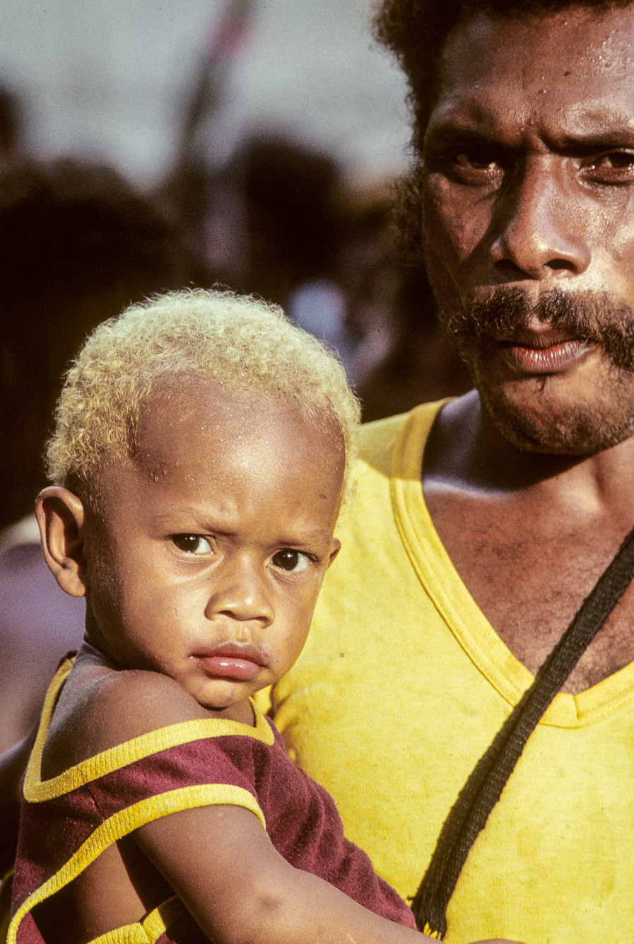 Nouvelle Guinée Papouasie. Rabaul, tribu des Tolaï. Beaucoup d'habitants sont blonds, à cause de la malnutrition qui sévit dans ses contrées perdues.